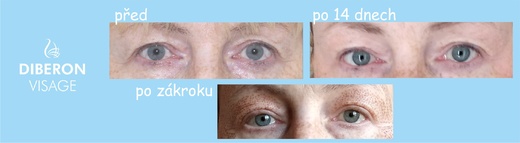 neinvazivní blefaroplastika očních víček plasma perem